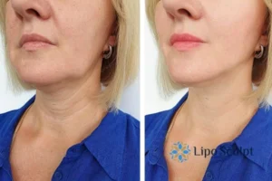 Double chin before and after Hi-Fu treatment 4 Book your double chin treatment Rickmansworth today! We are here to help!