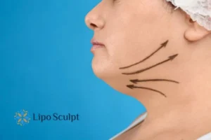 Double chin before and after Hi-Fu treatment 3 Boost your confidence with a Double chin treatment Rickmansworth