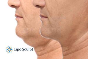 Double chin before and after Hi-Fu treatment 2 Double chin treatment Rickmansworth from Lipo Sculpt - feel more confident today!