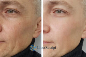 How to Fight Aging Symptoms 3 Fight Aging Symptoms Rickmansworth With HIFU and Morpheus8 Today!