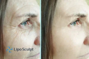 How to Fight Aging Symptoms 2 Do you want to Fight Aging Symptoms Rickmansworth? Contact Lipo Sculpt today!