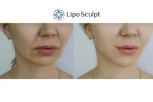 Explaining Total Skin Tightening Treatment And What It Can Do For You 2 Do you want to boost your self confidence? Give Morpheus8 Rickmansworth a try today!