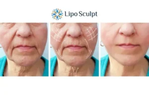 Explaining Total Skin Tightening Treatment And What It Can Do For You 3 Boost your confidence with Morpheus8 Rickmansworth call our team today!