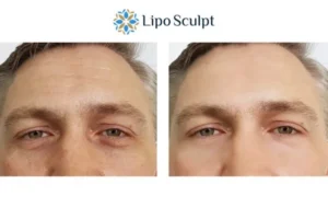 Explaining Total Skin Tightening Treatment And What It Can Do For You 6 Morpheus8 Rickmansworth book in today to find out more!
