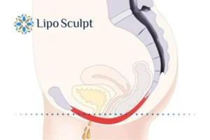 Pelvic Floor Chair Therapy 1 Pelvic Floor Chair Therapy Rickmansworth to treat incontinence.