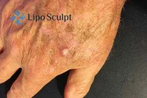 Best Actinic Keratoses Removal 2 Improve your wellbeing and health with Actinic Keratoses Rickmansworth removal.treatment