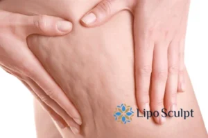 CoolSculpting for Legs: The Innovative Approach to Redefining Your Legs 5 Start your journey today book your coolsculpting treatment Rickmansworth online today!