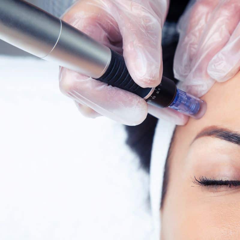 Morpheus8 treatment Rickmansworth from Lipo Sculpt - Book in today!