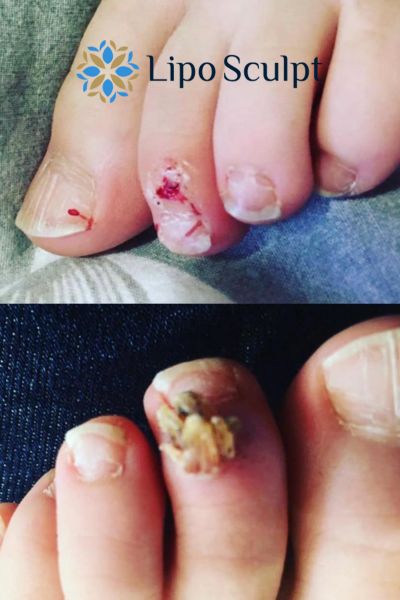 Wart removal customer results from Lipo Sculpt Rickmansworth